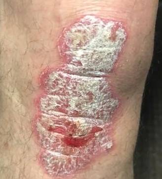Psoriasis Before and After Case 27 Before