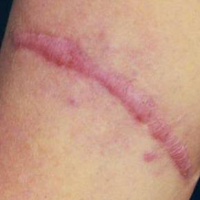 Picocare 450 Before and After Case 3 Before