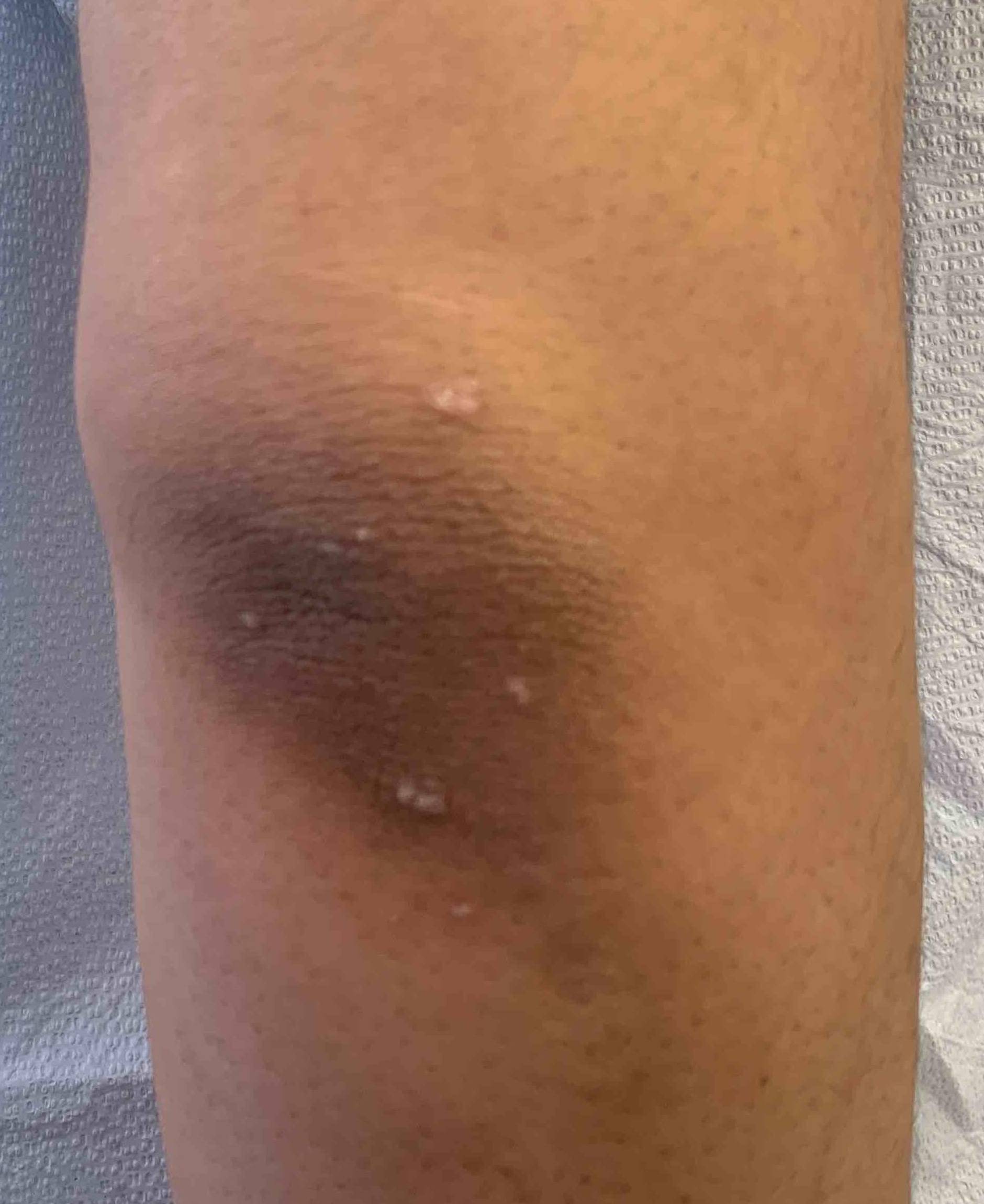 Psoriasis Before and After Case-28 Before