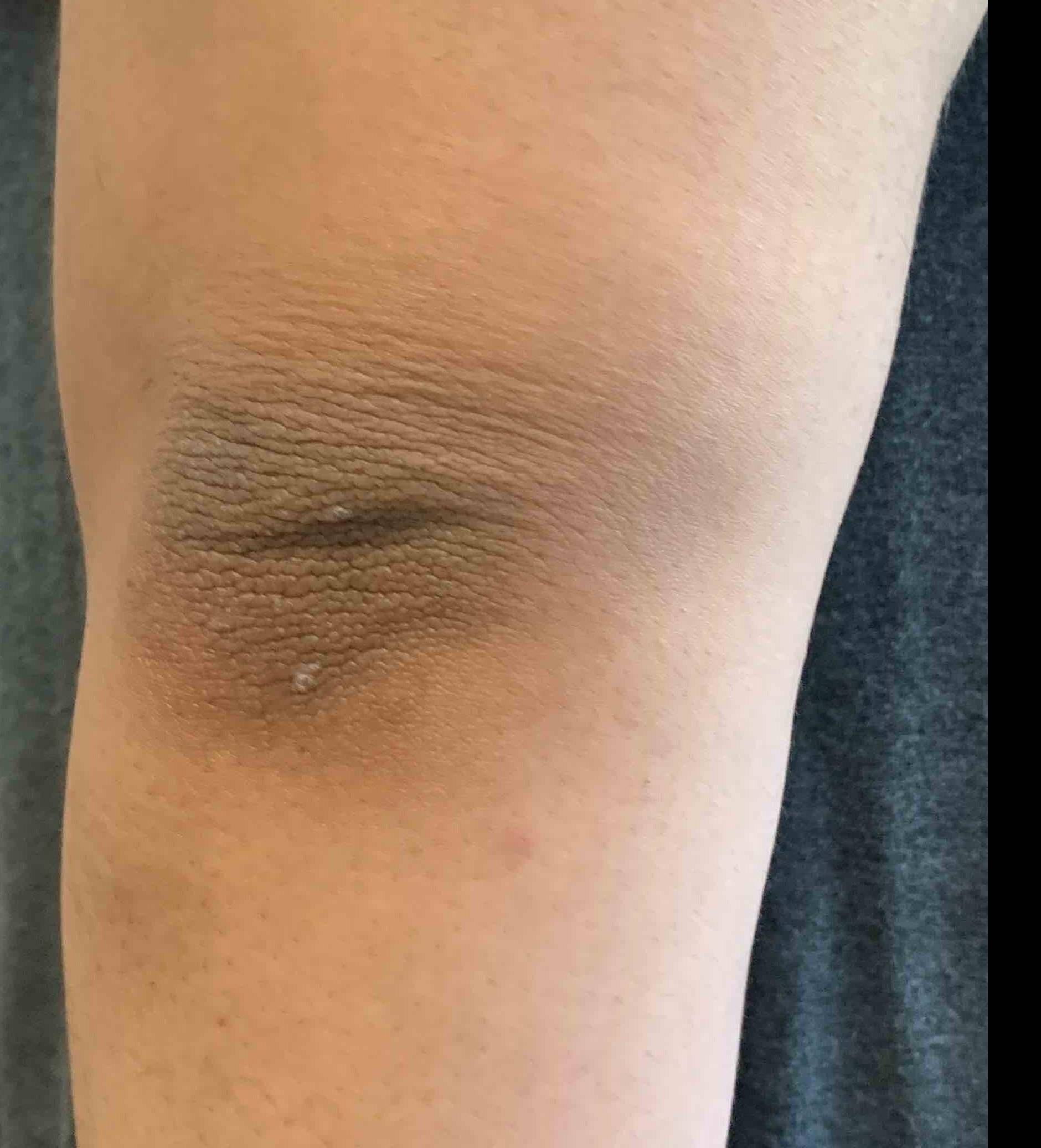 Psoriasis Before and After Case-28 After