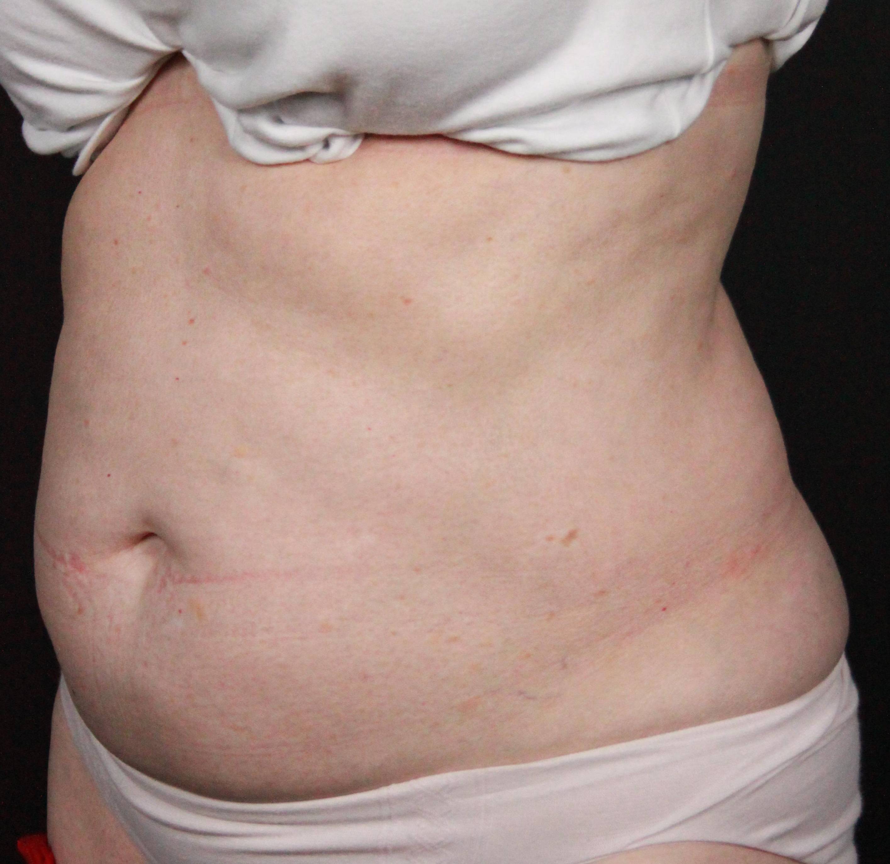 CoolSculpting<sup>®</sup> Before and After Case 16 Before
