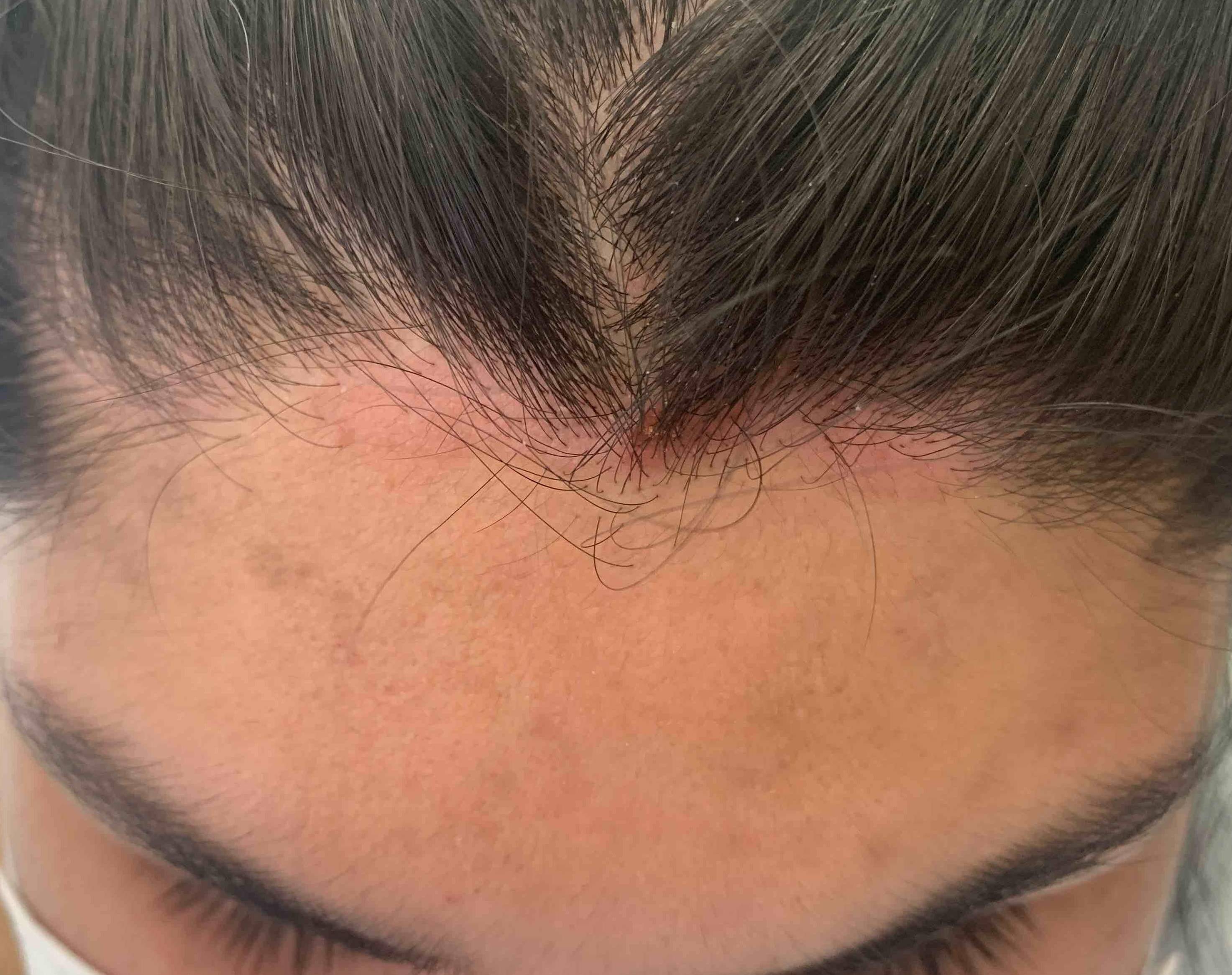 Psoriasis Before and After Case-29 After