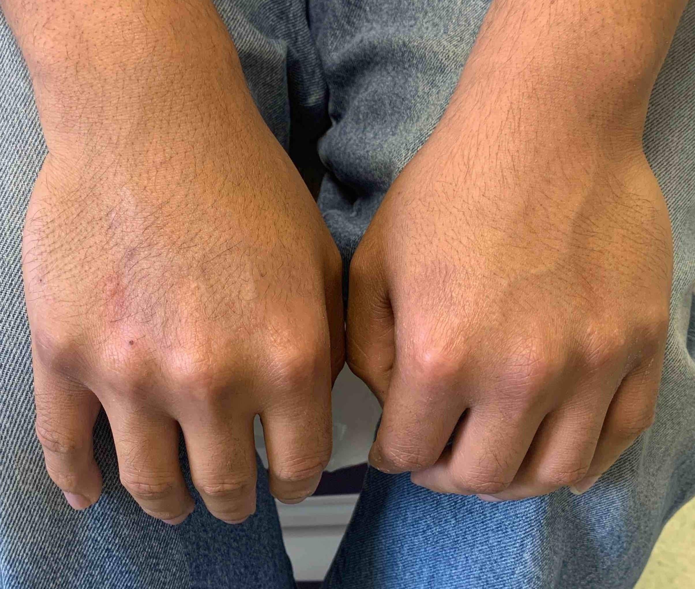Eczema/ Atopic Dermatitis Before and After Case 12 After