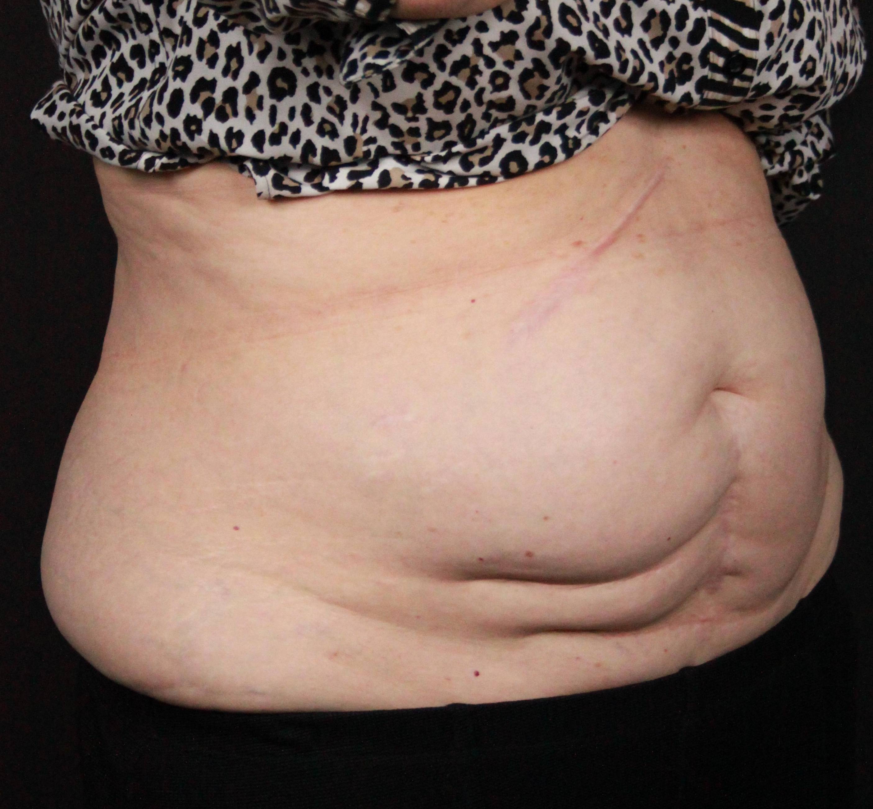 CoolSculpting<sup>®</sup> Before and After Case 17 Before