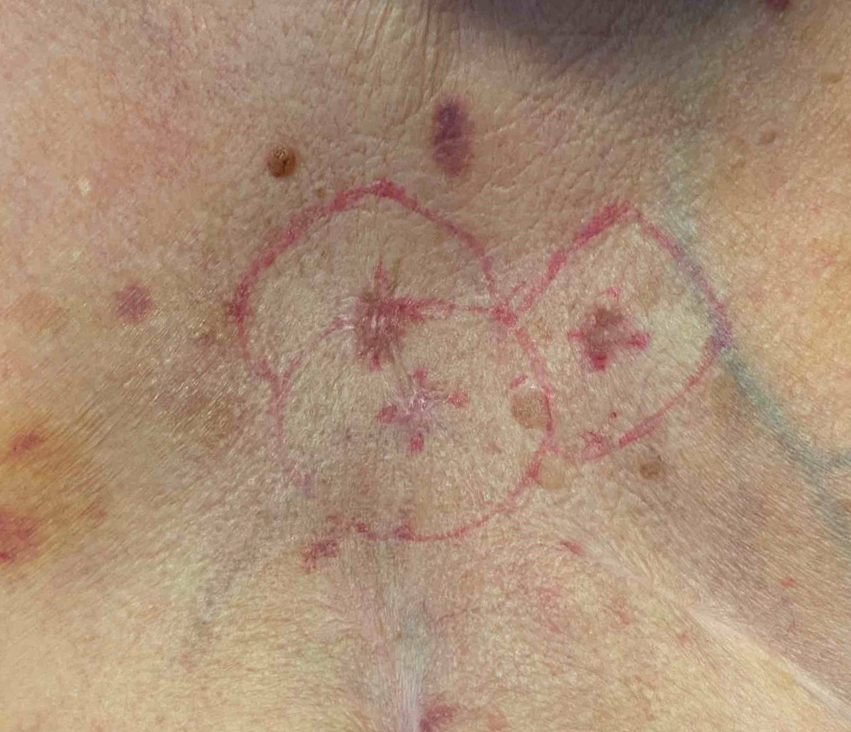 Skin Cancer Case Before and After 17 Before