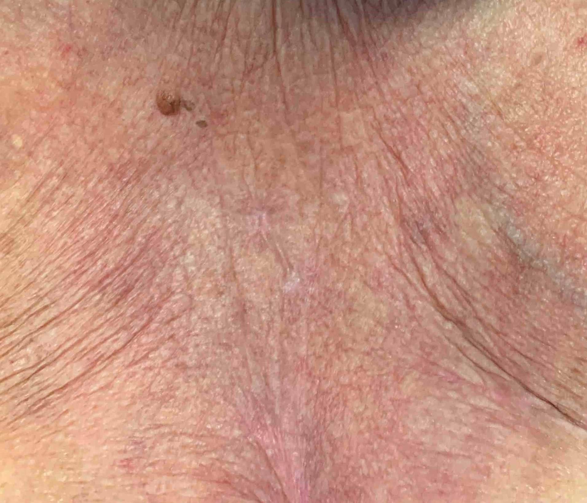 Skin Cancer Case Before and After 17 After
