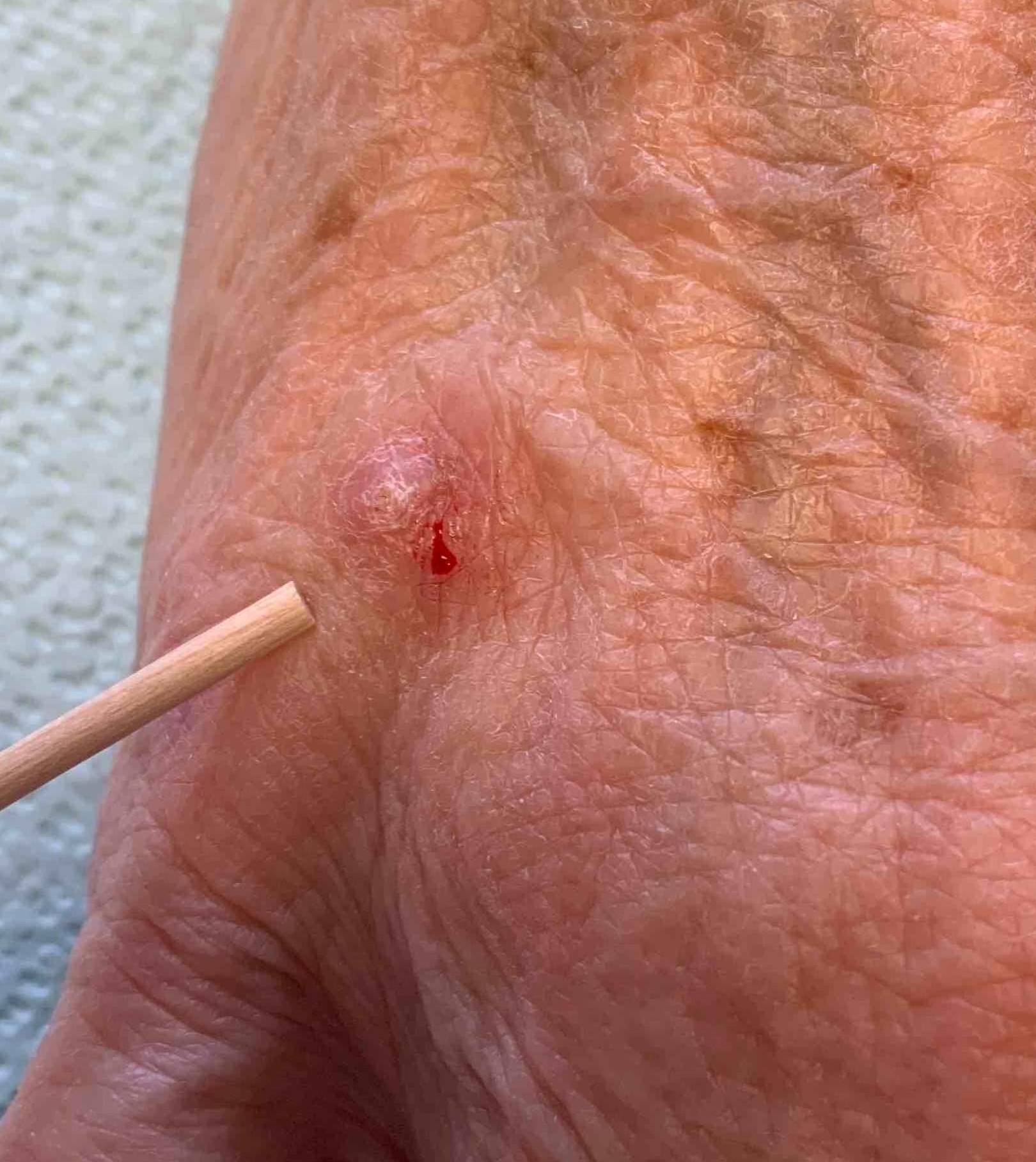 Skin Cancer Before and After Case 18 Before