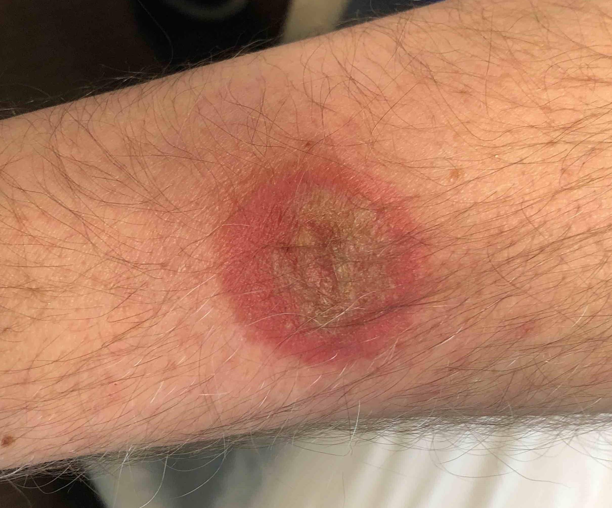 Skin Cancer Before and After Case 19 Before