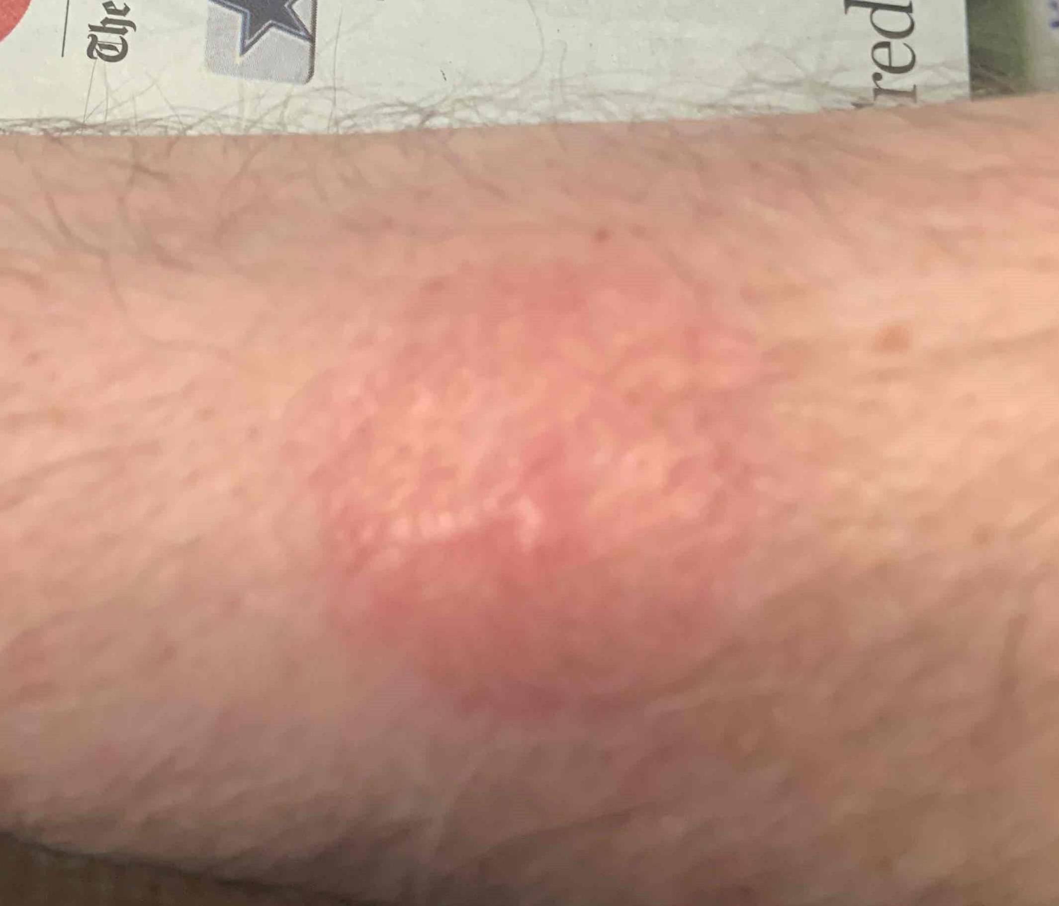 Skin Cancer Before and After Case 19 After