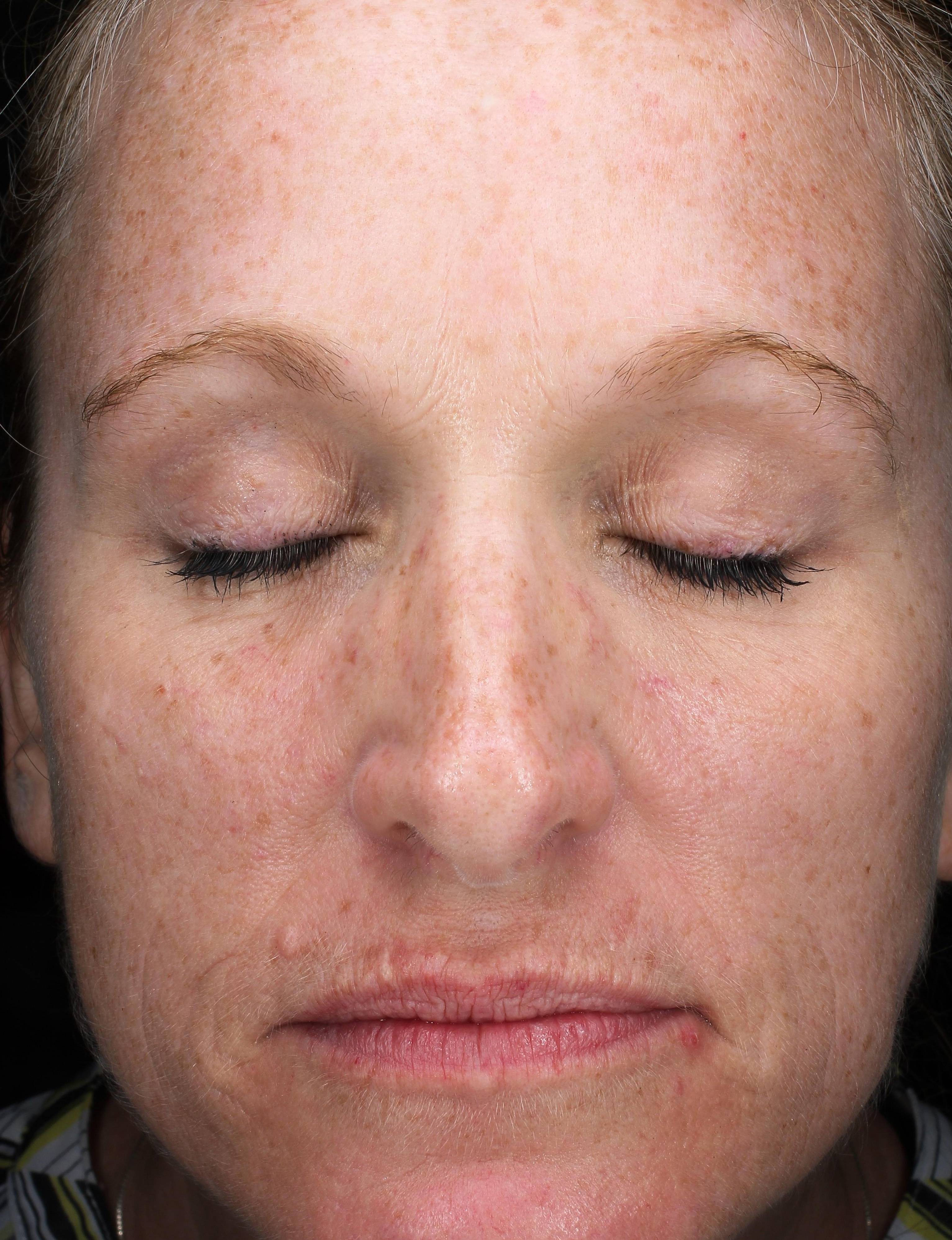 Secret RF Microneedling Before and After Case 4 Before