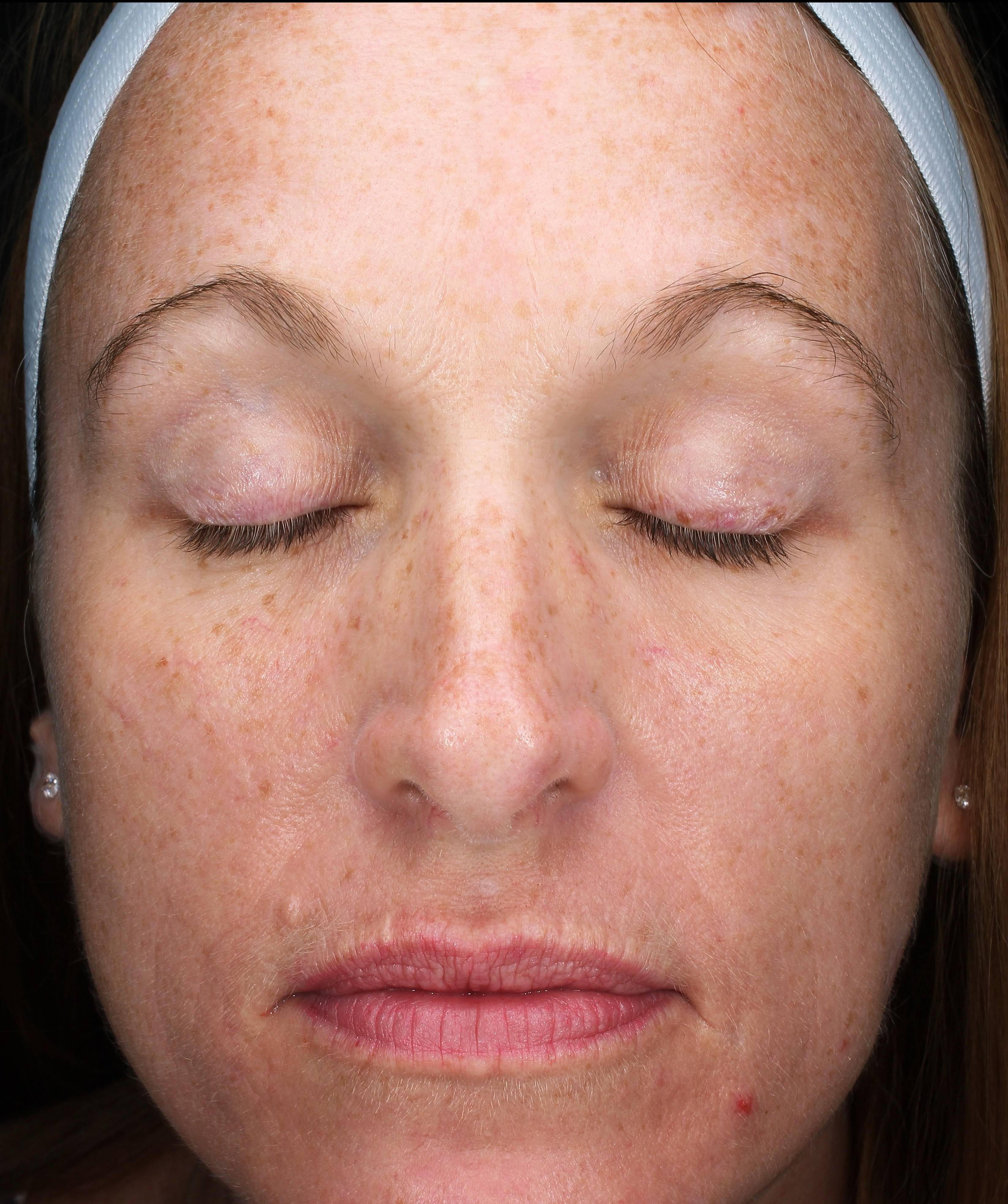 Secret RF Microneedling Before and After Case 4 After