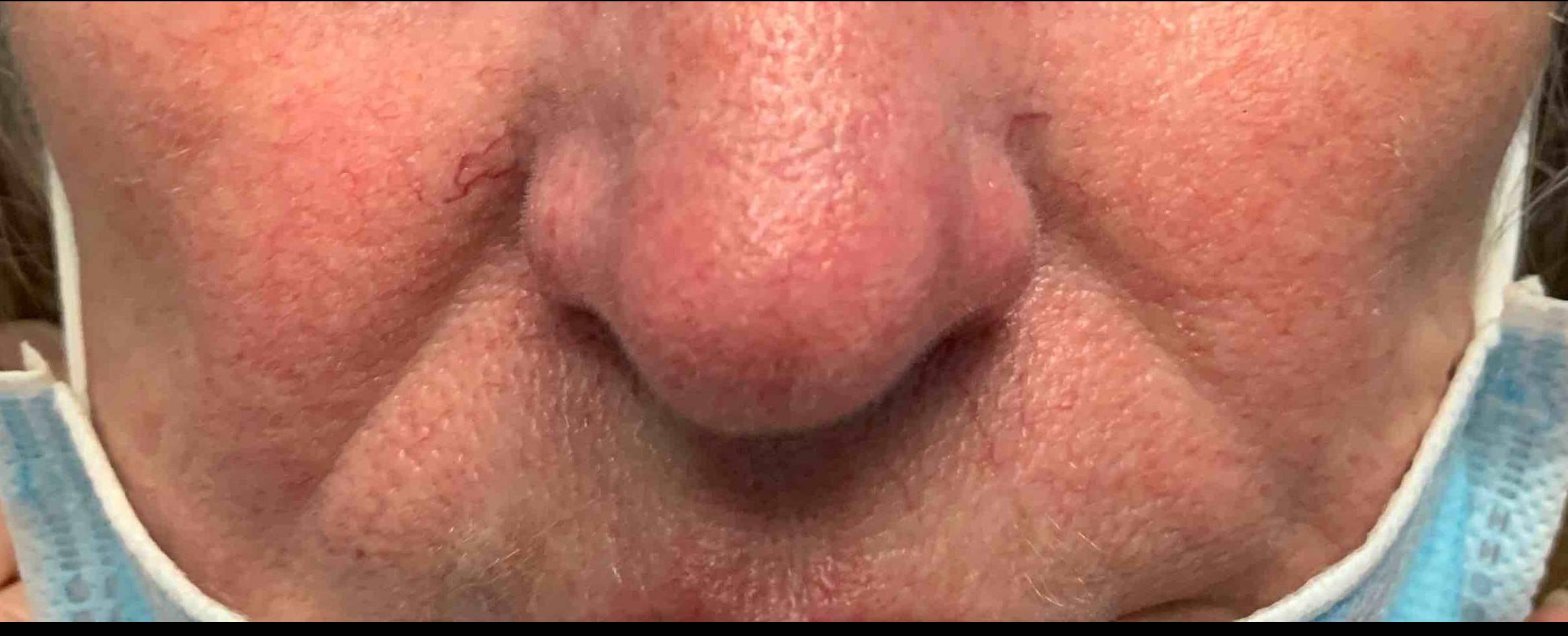 Eczema/ Atopic Dermatitis Before and After Case 13 Before