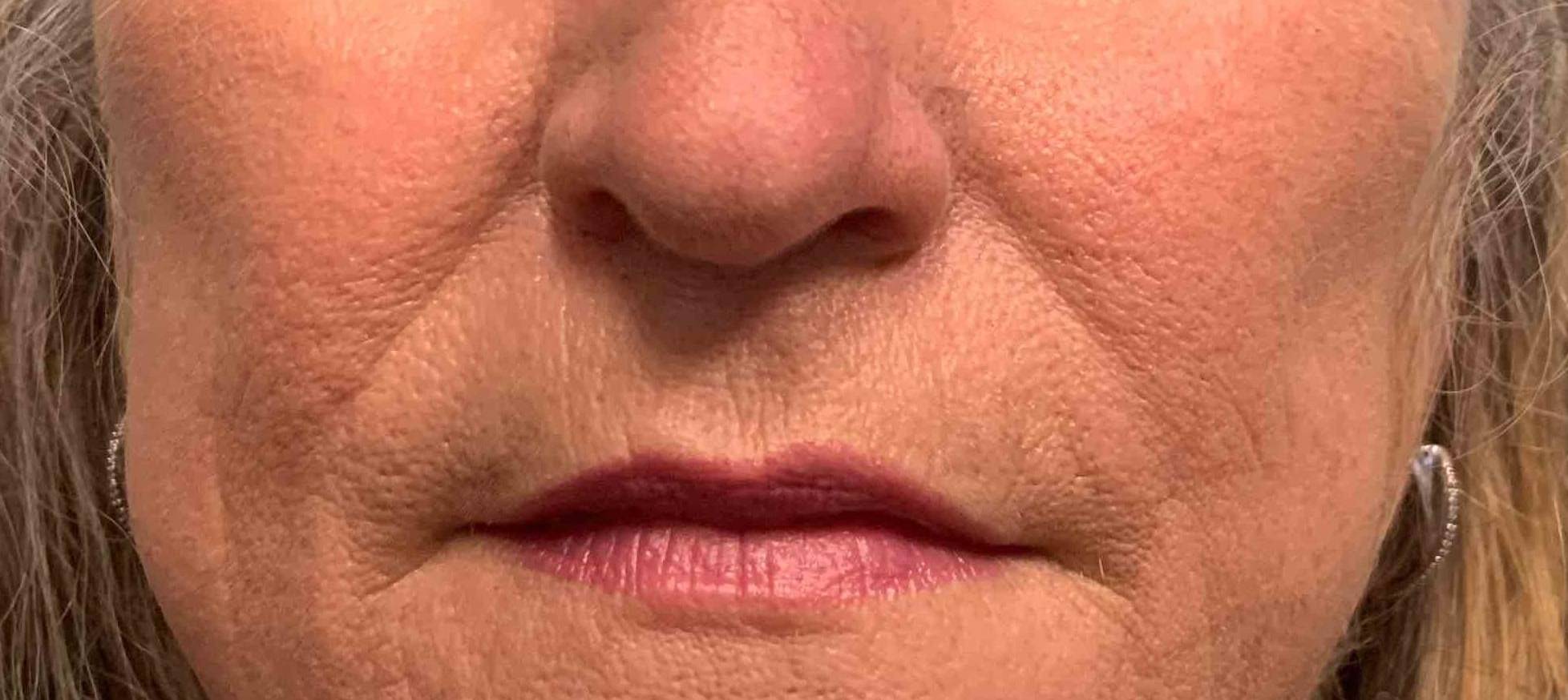 Eczema/ Atopic Dermatitis Before and After Case 13 After