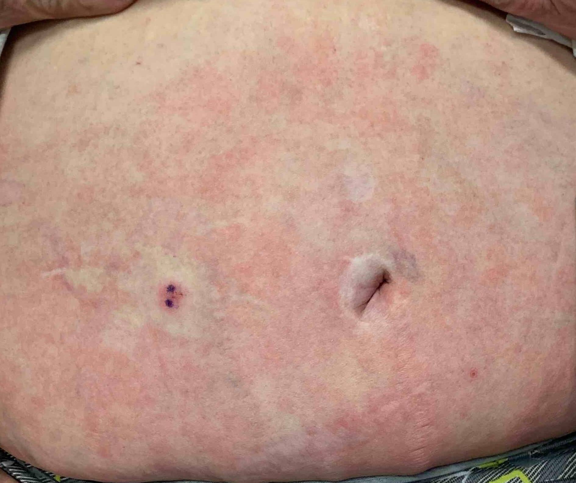 Eczema/ Atopic Dermatitis Before and After Case 14 Before
