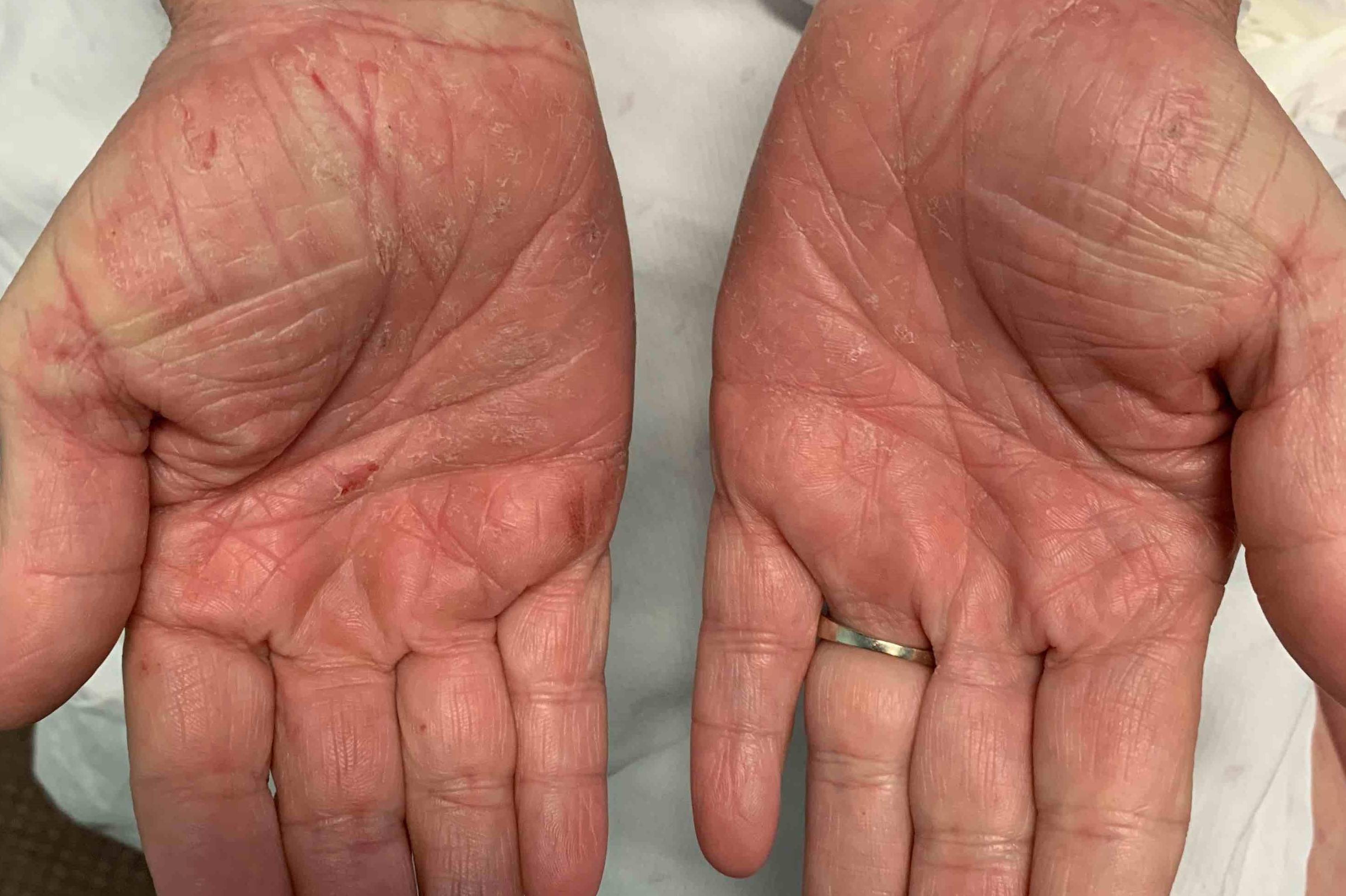 Eczema/ Atopic Dermatitis Before and After Case 15 Before