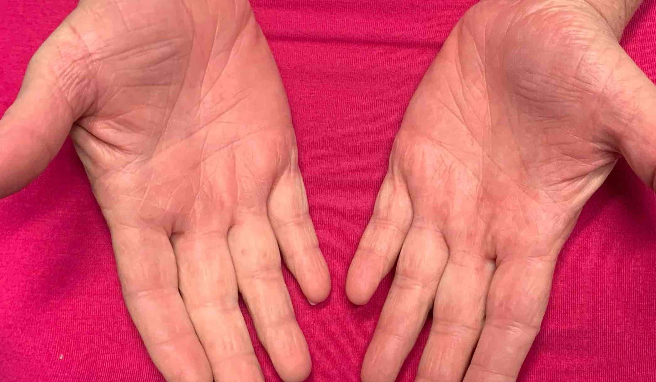 Eczema/ Atopic Dermatitis Before and After Case 15 After