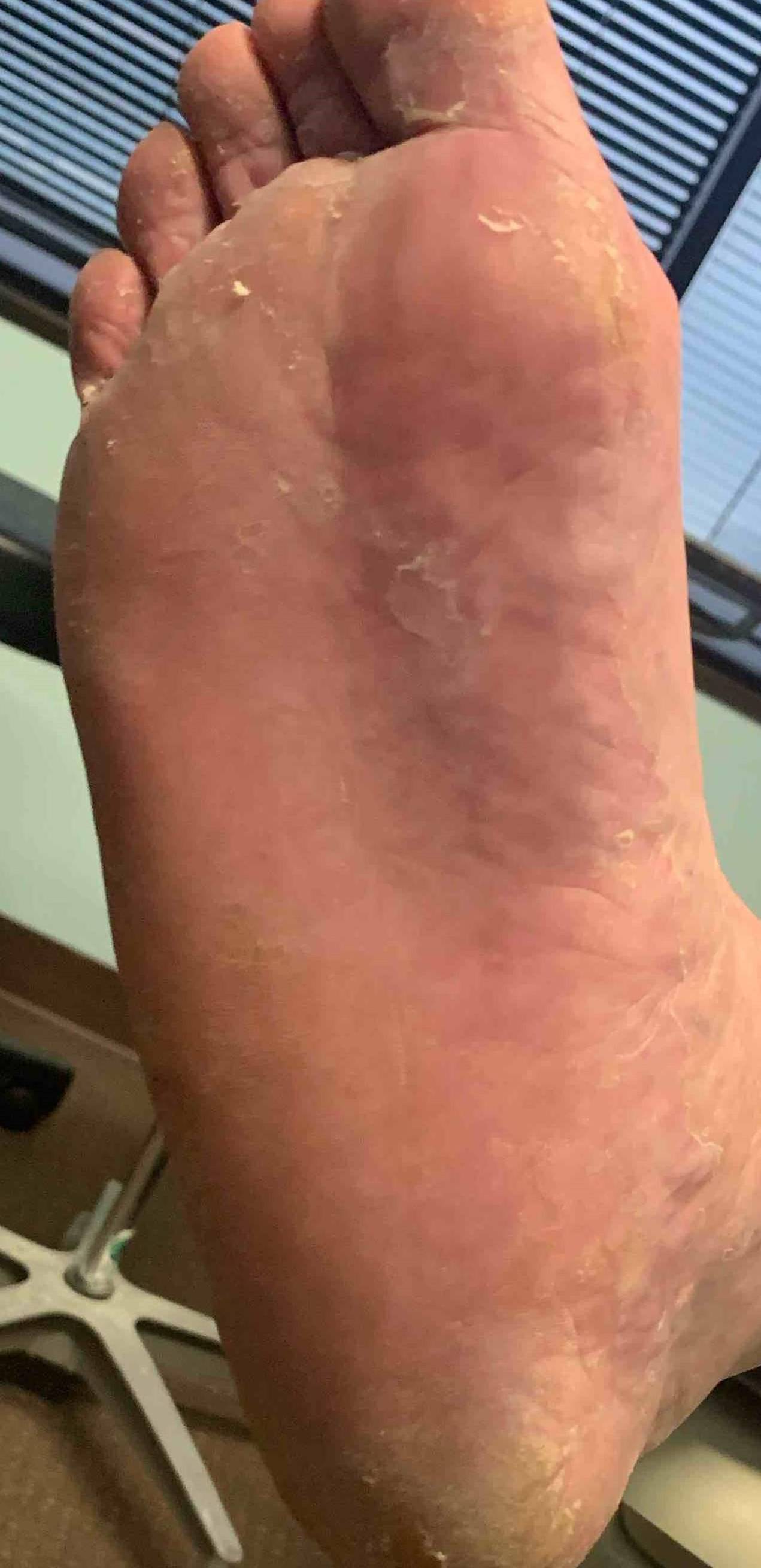 Eczema/ Atopic Dermatitis Before and After Case 16 After