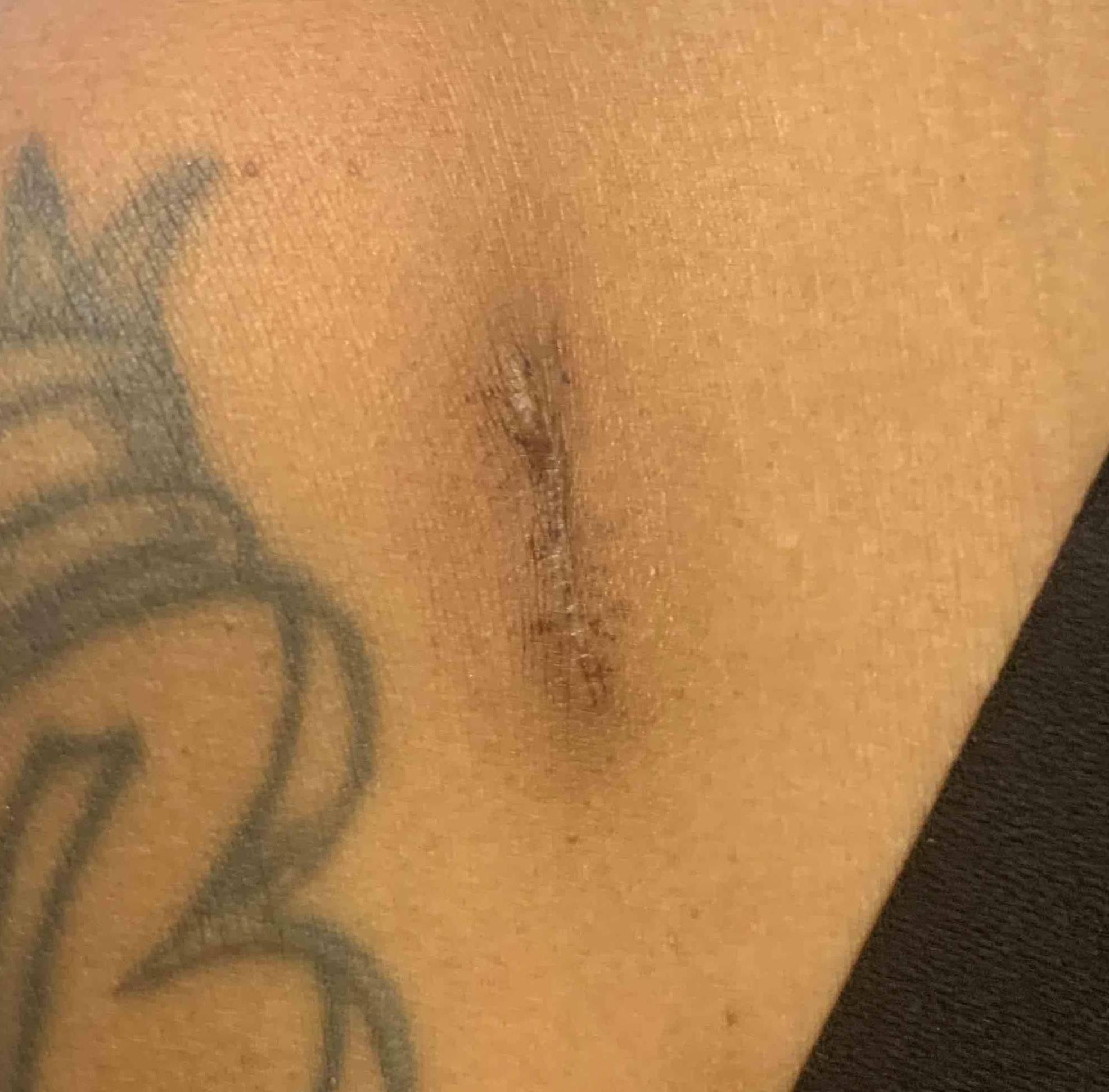 Keloids Before and After Case 13 After
