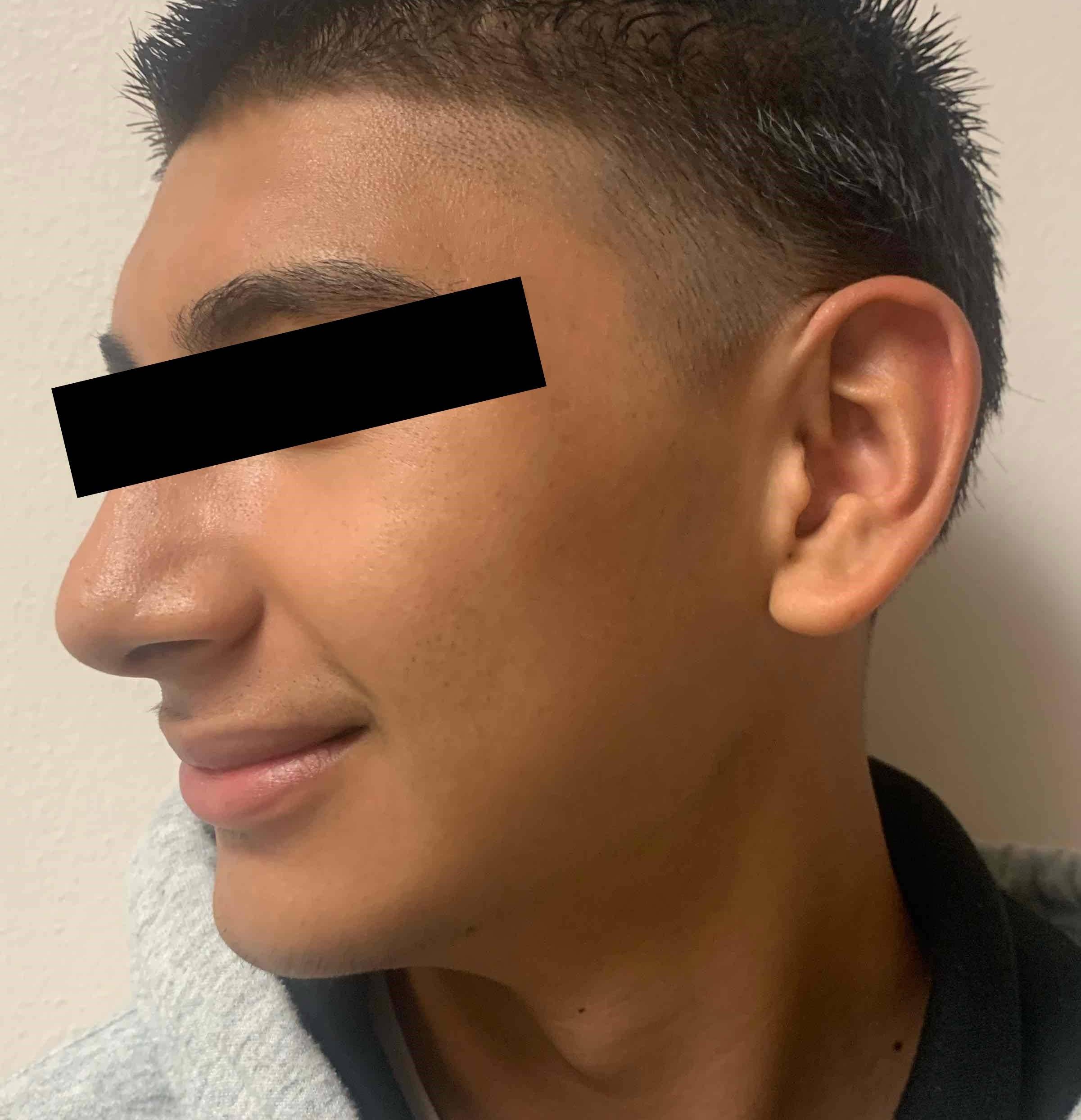 Acne Before and After Case 14 After