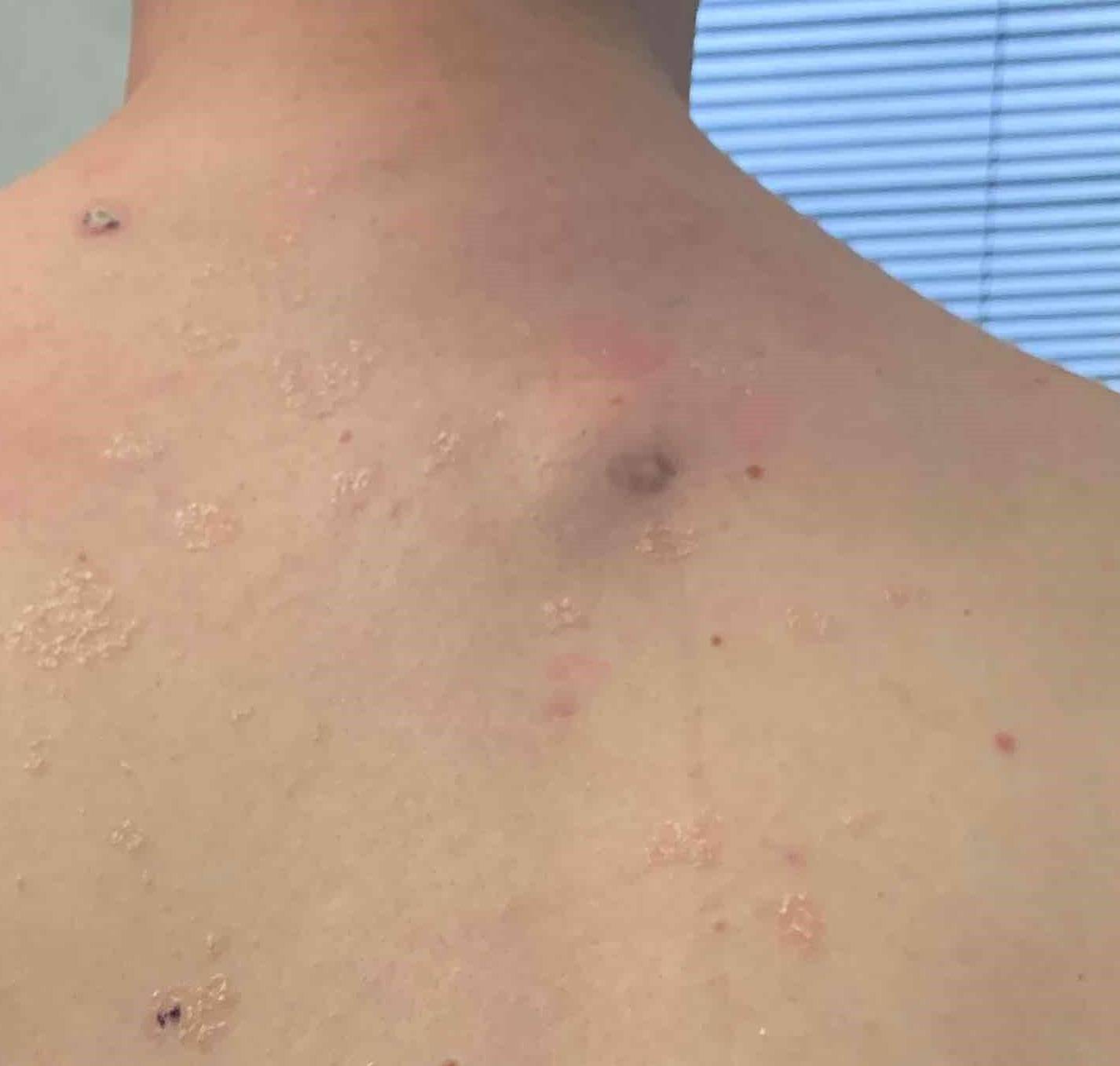 Lipoma Before and After Case 1 Before