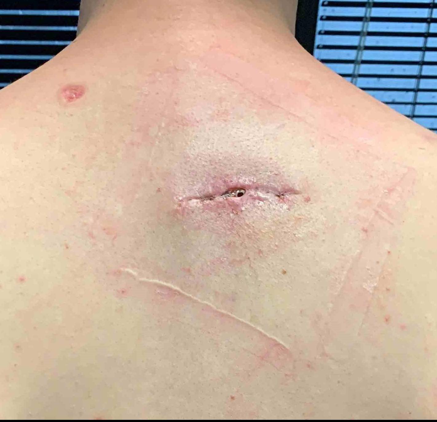 Lipoma Before and After Case 1 After