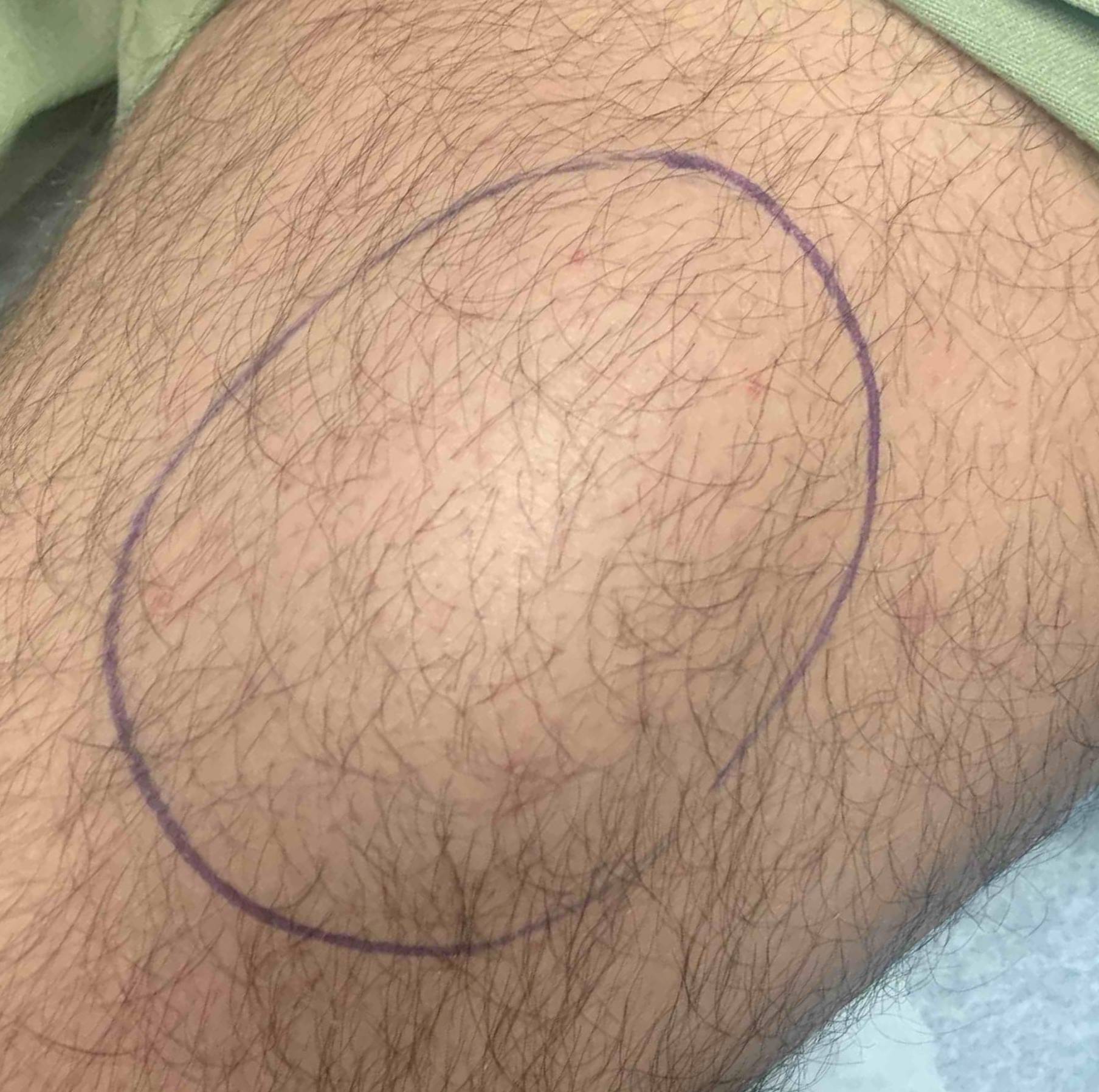 Lipoma Before and After Case 2 After