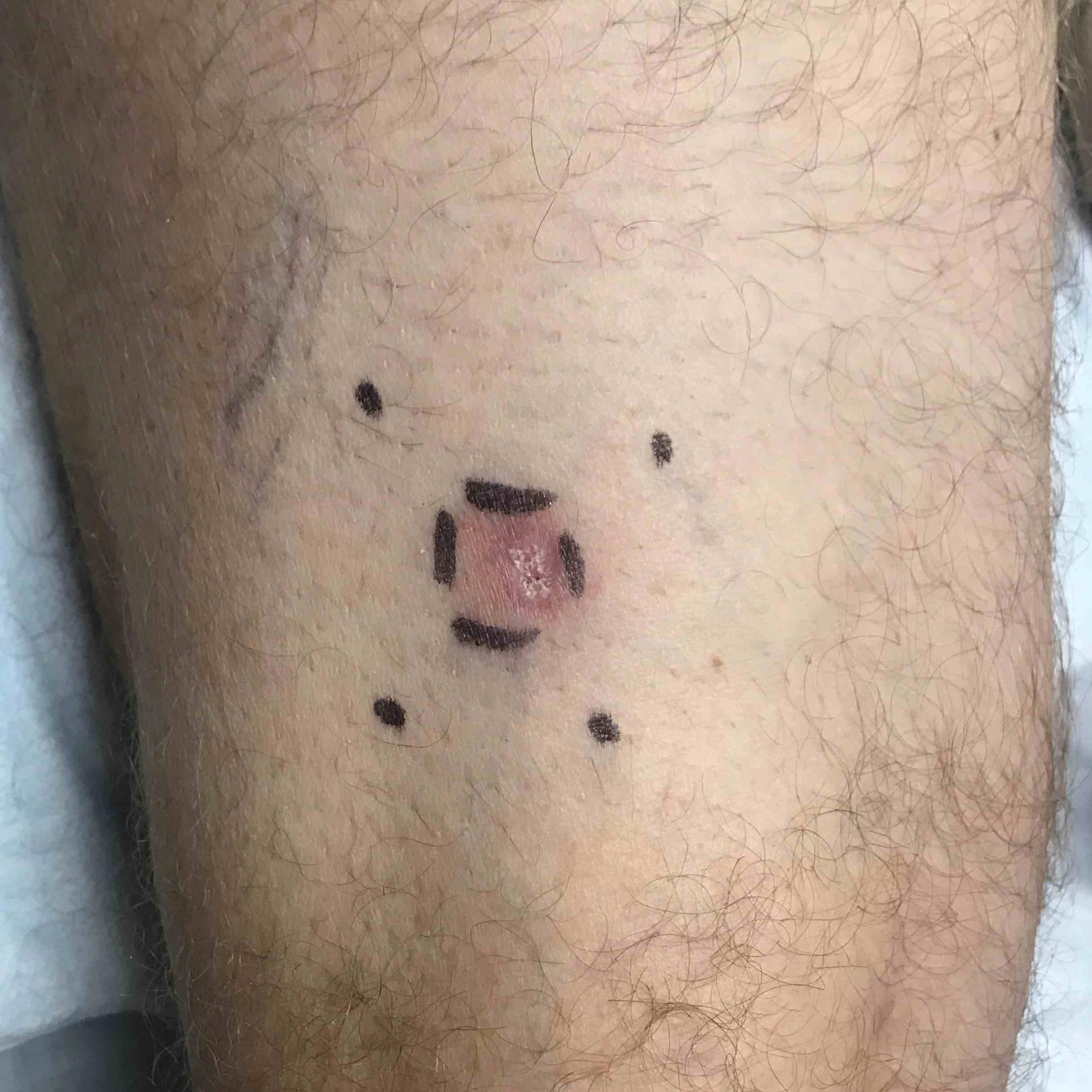 Skin Cancer Before and After Case 21 Before