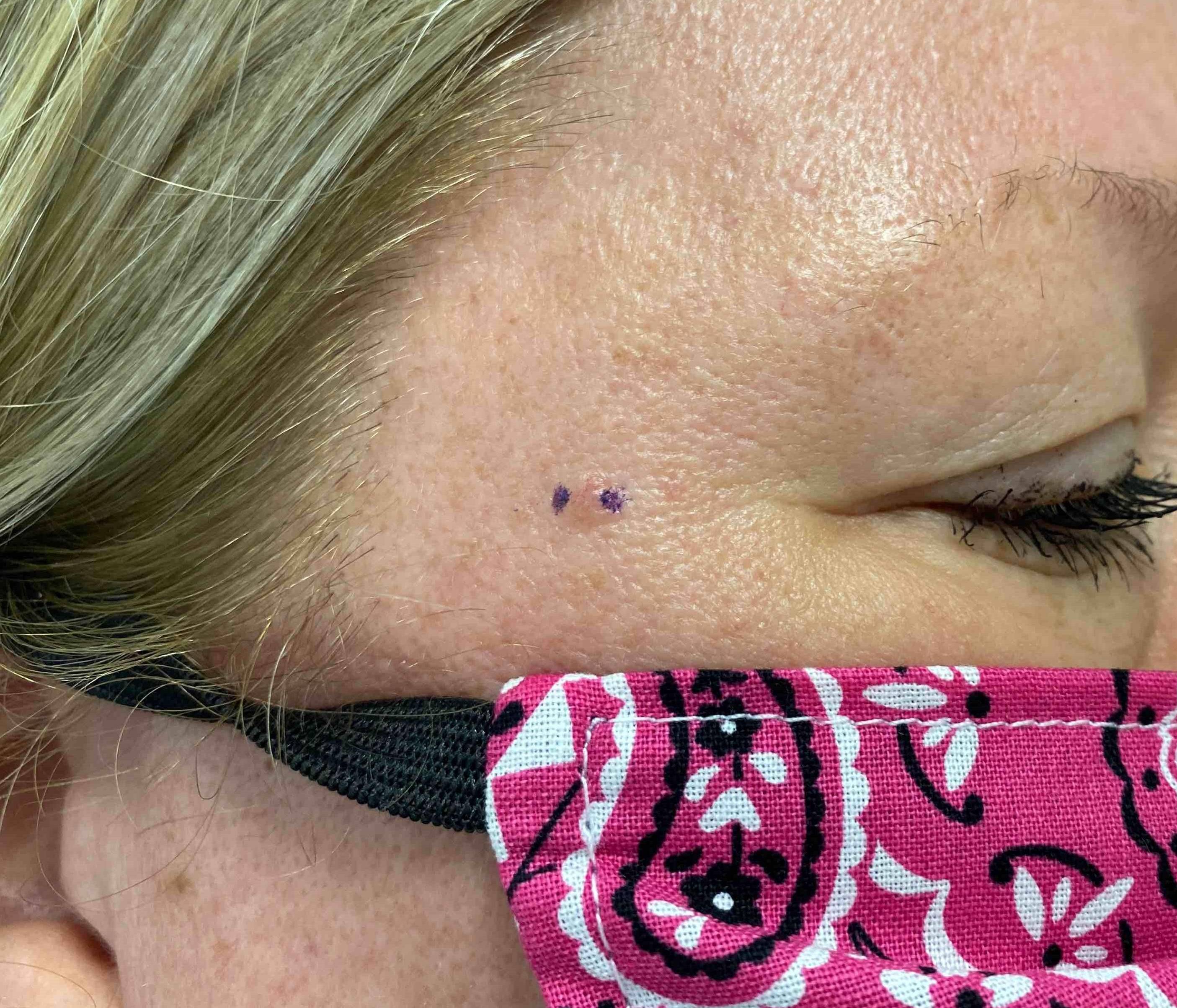 Skin Cancer Before and After Case 22 Before
