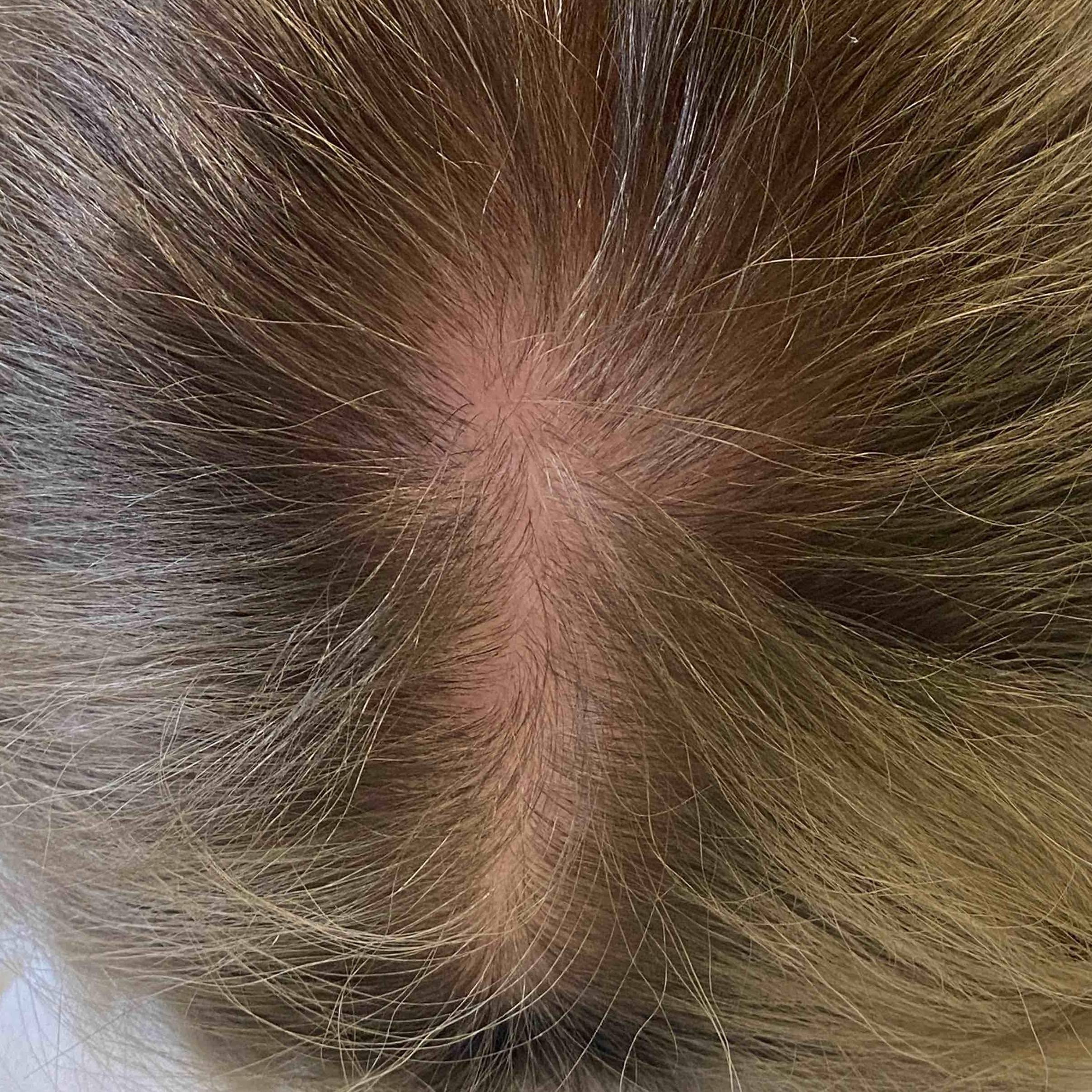 Exoflo-Hair Restoration Before and After Case 3 Before