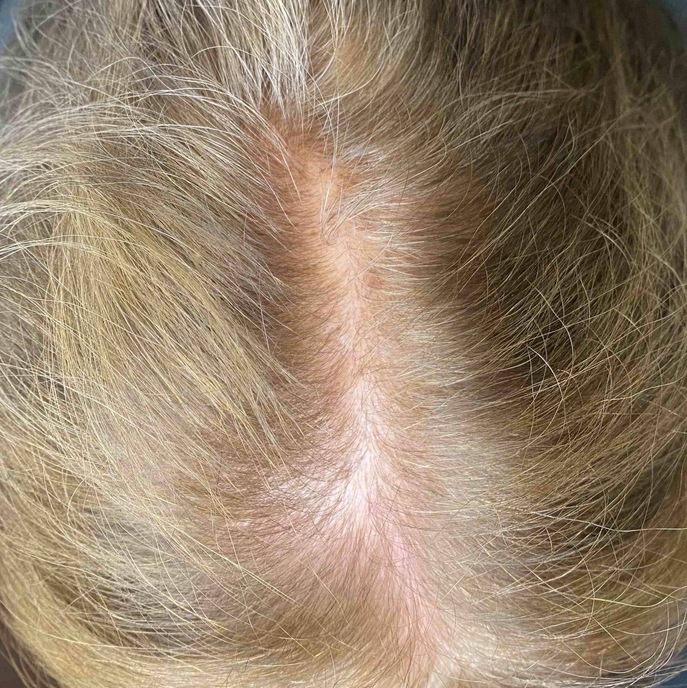 Exoflo-Hair Restoration Before and After Case 3 After