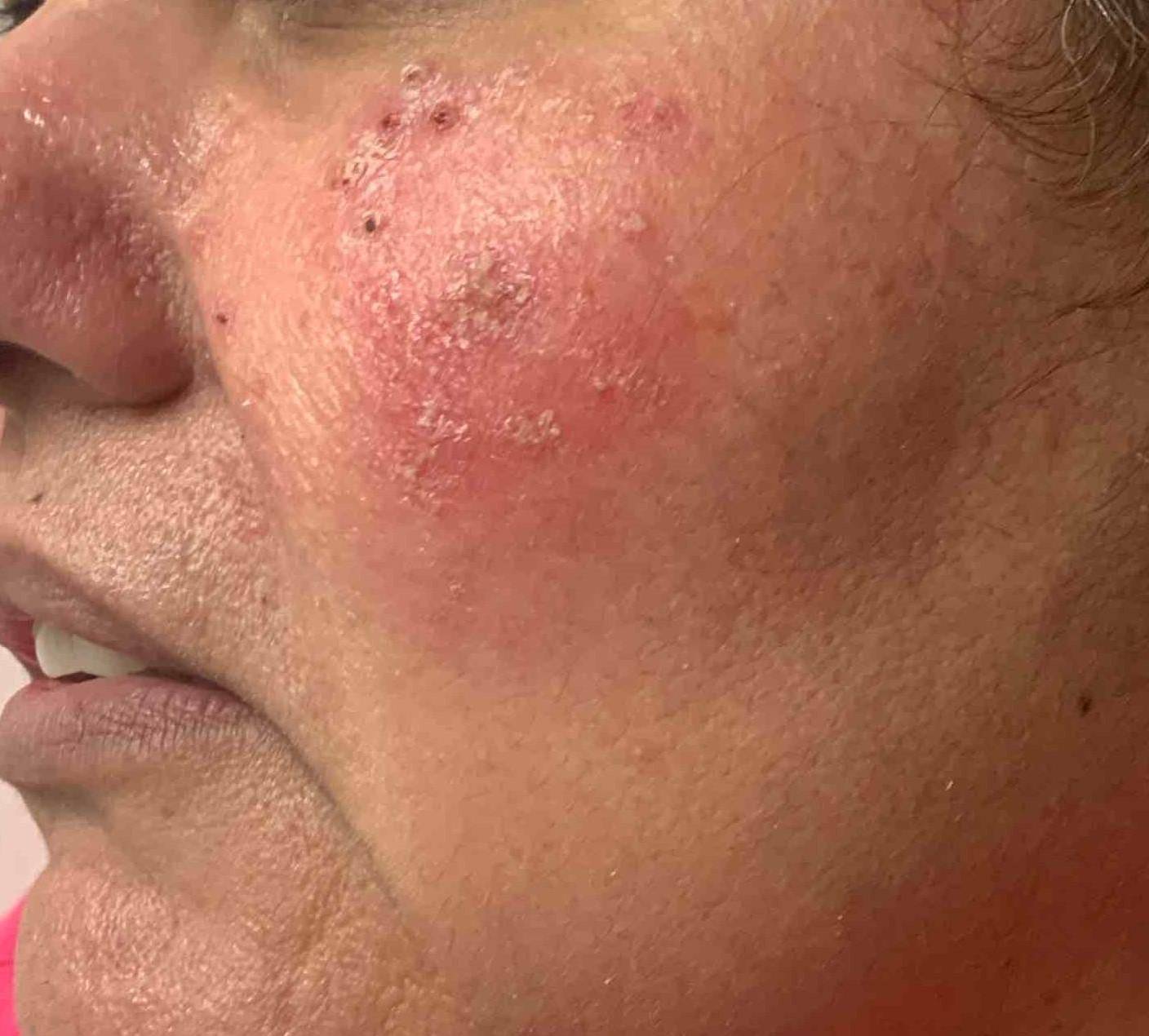 Rosacea Before And After Case 5 After
