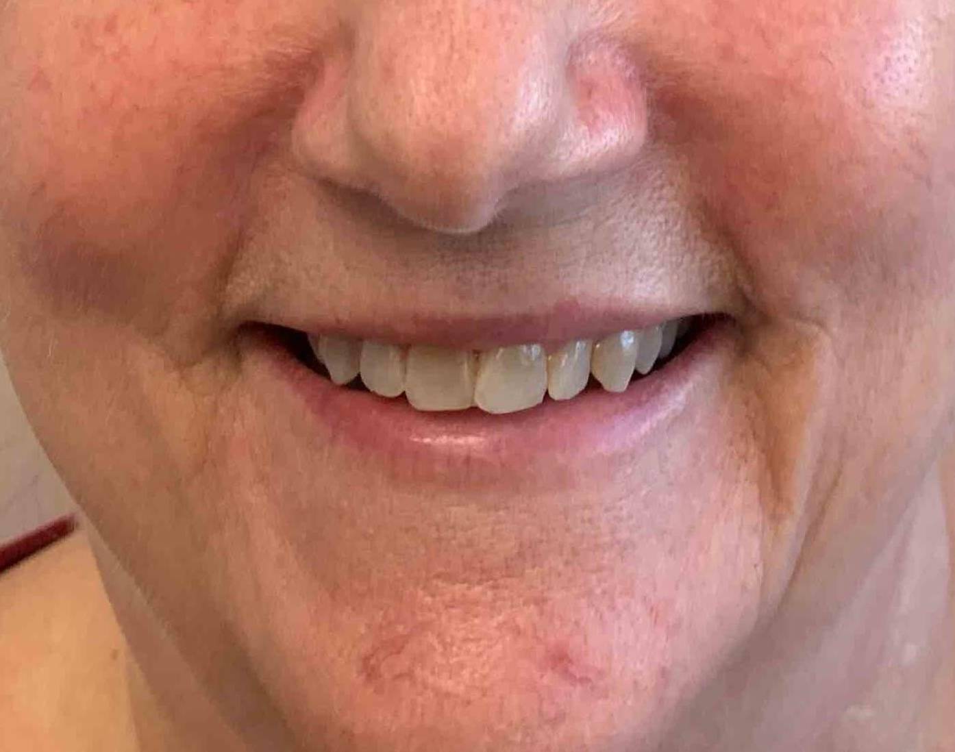 Rosacea Before And After Case 6 After