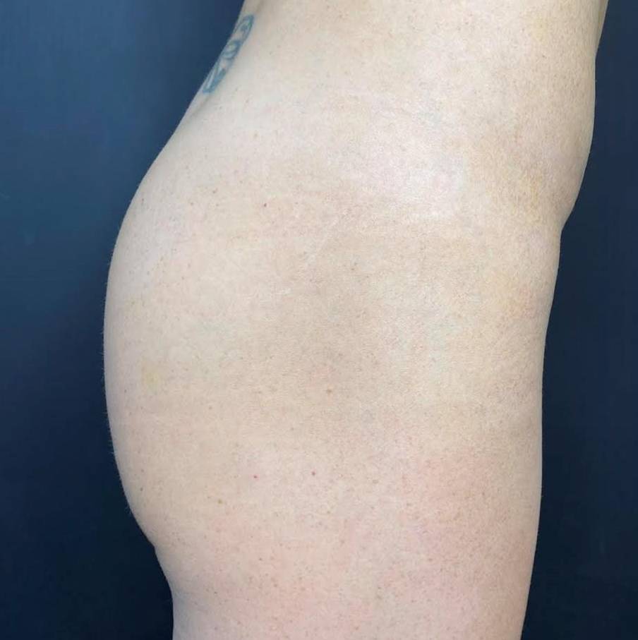 Sculptra (15 Vials) Case 5 Before