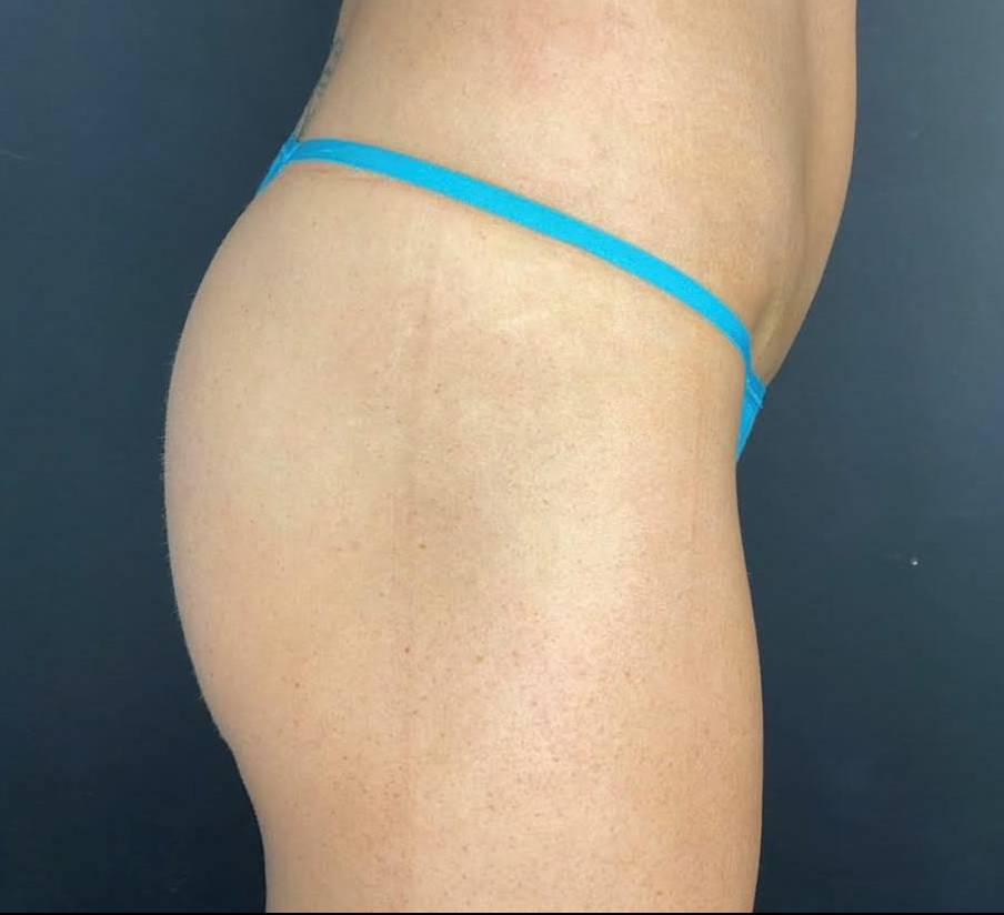 Sculptra (15 Vials) Case 5 After