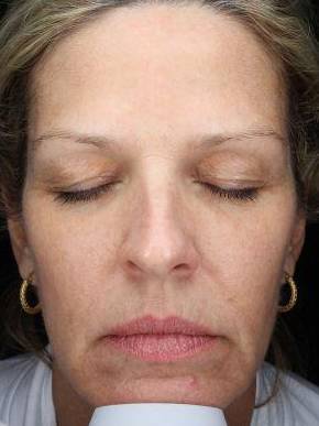 IPL-Photofacial/BBL Before and After Case 1 After