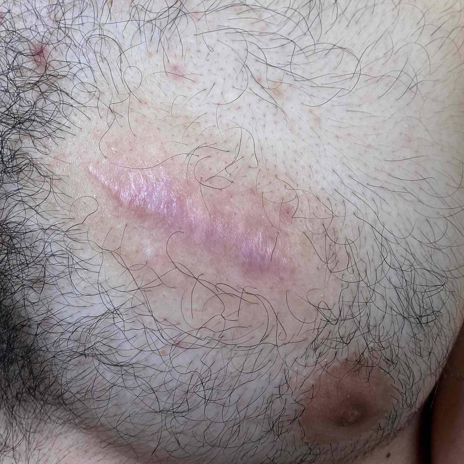 Microneedling Before and After Case 5 Before