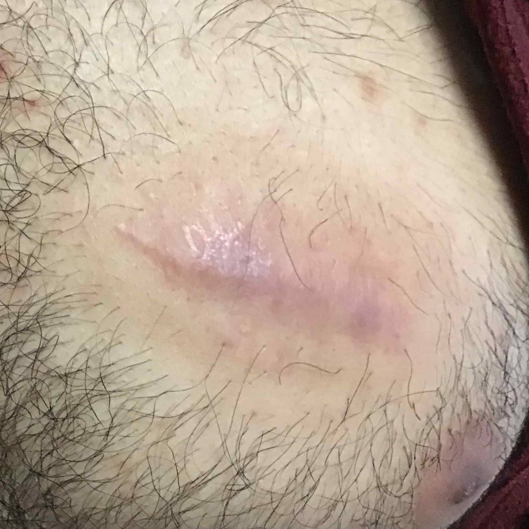 Microneedling Before and After Case 5 After