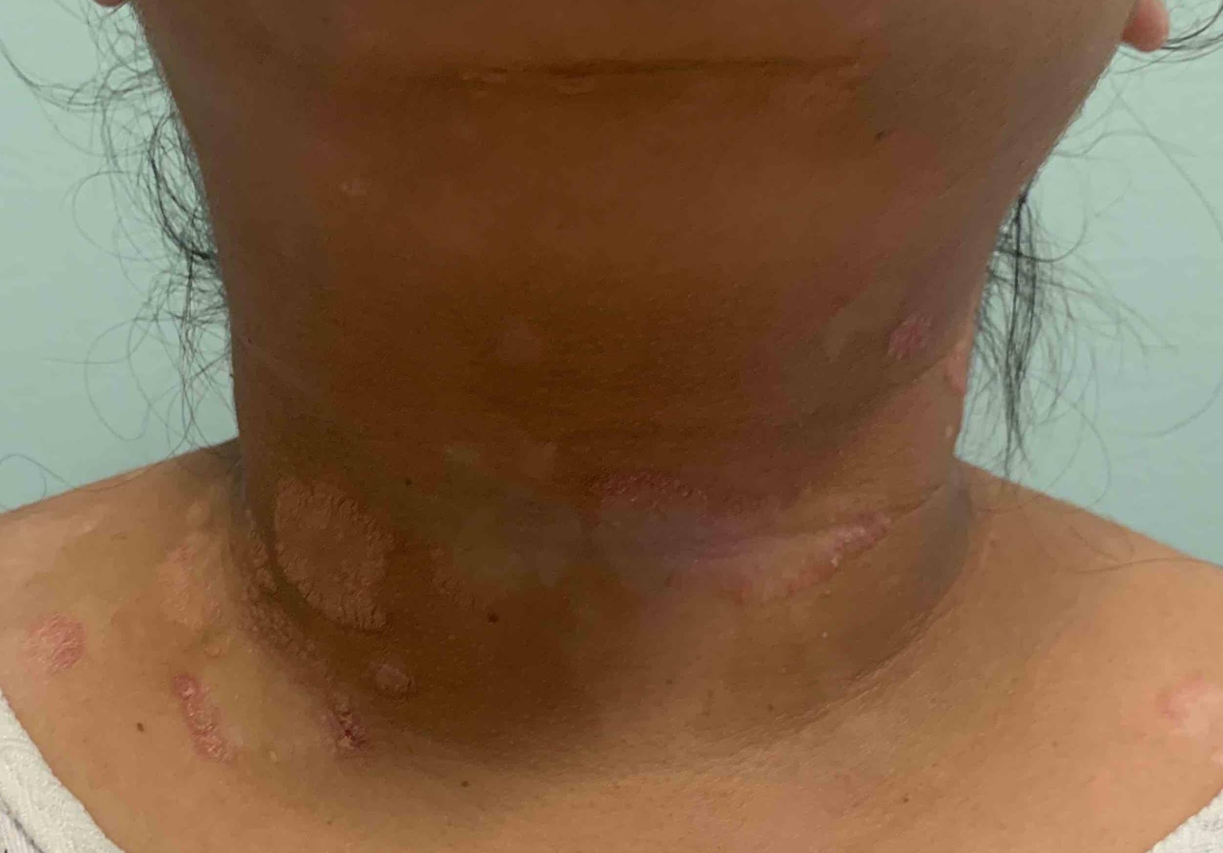Psoriasis Before and After Case-30 Before