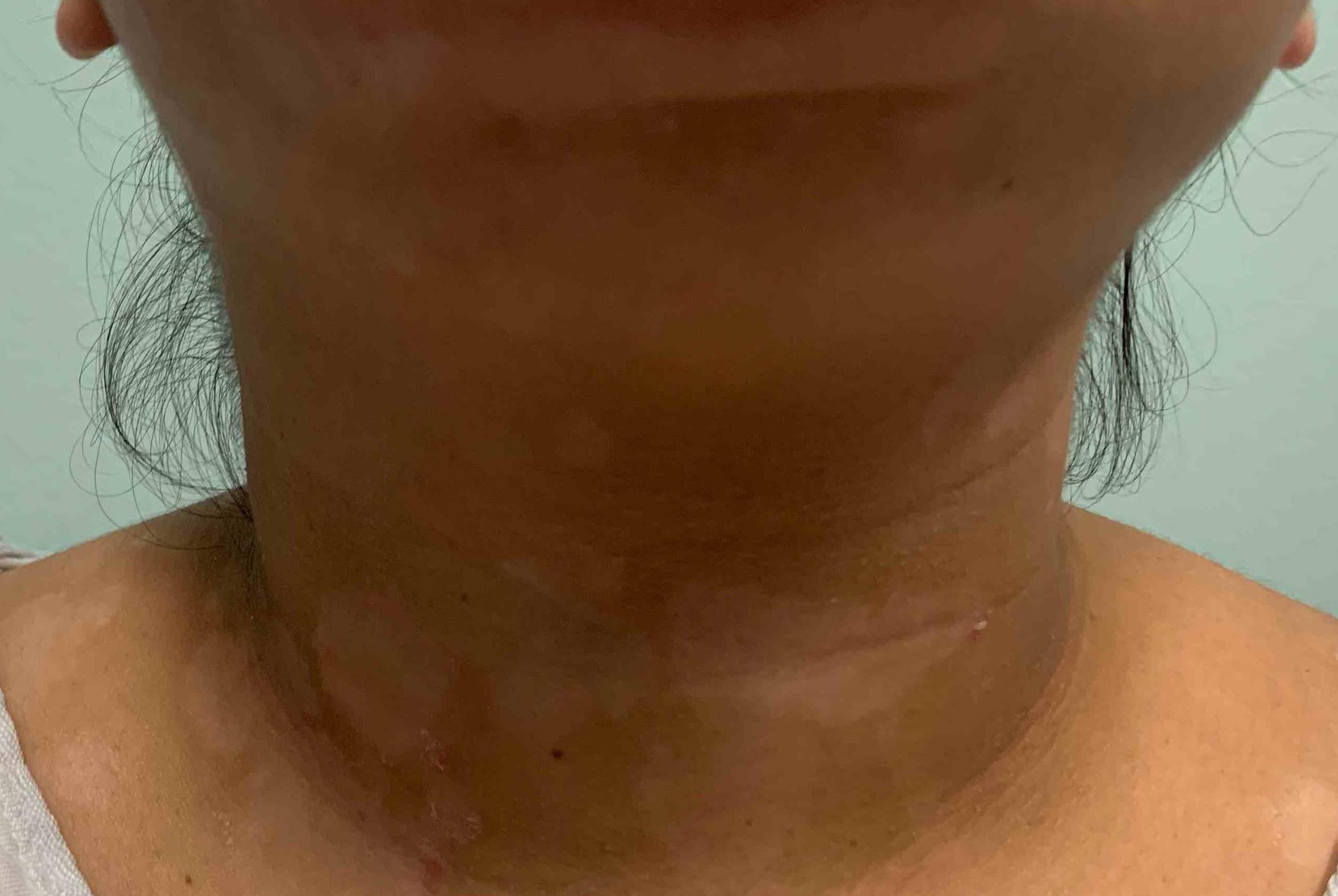 Psoriasis Before and After Case-30 After