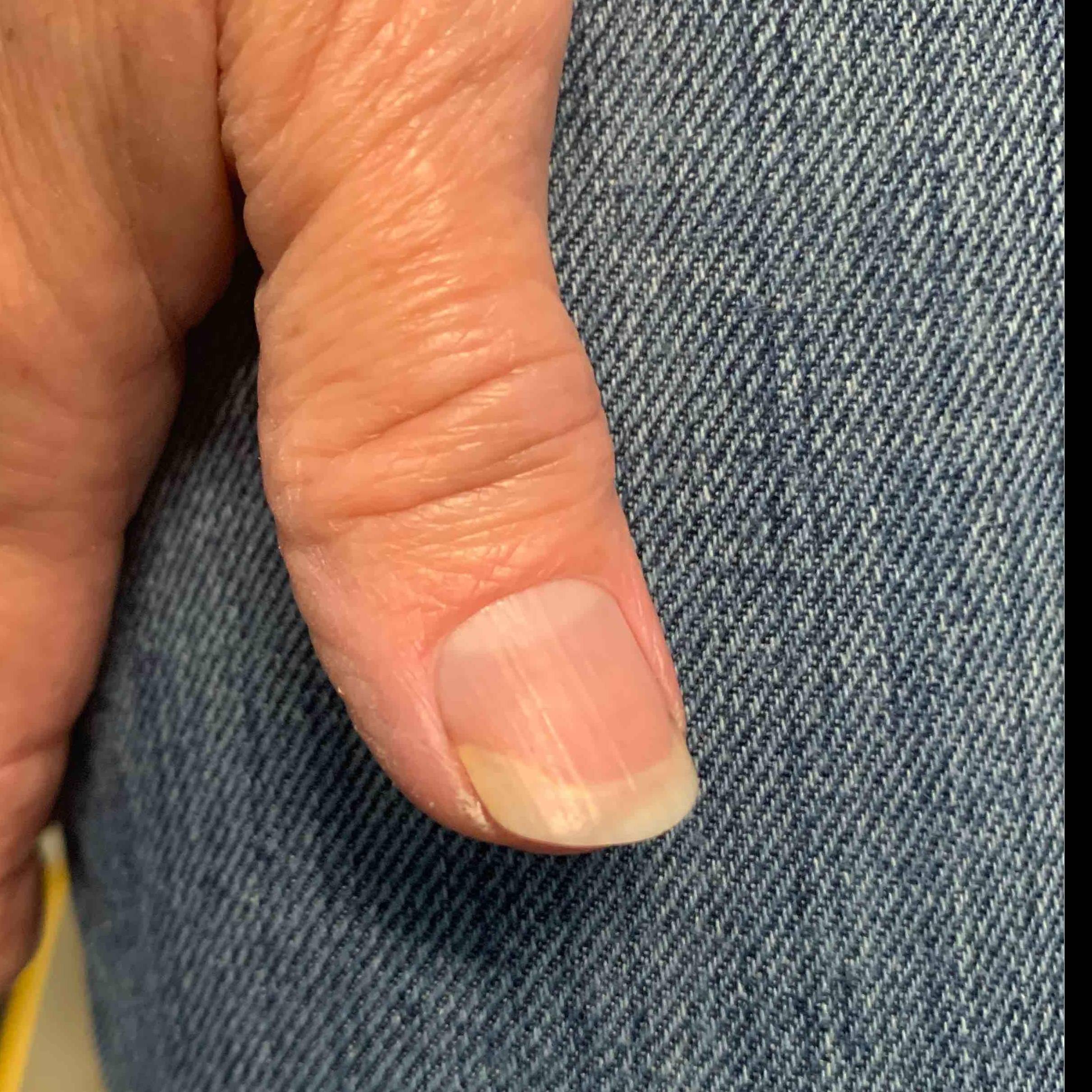 Fungus Before and After Case 4 After