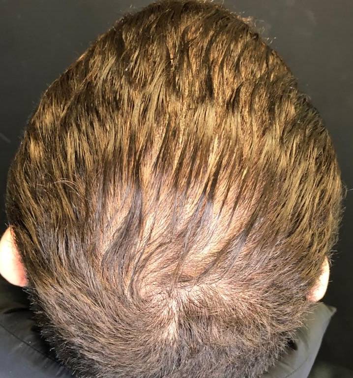 Exoflo-Hair Restoration Before and After Case 4 Before