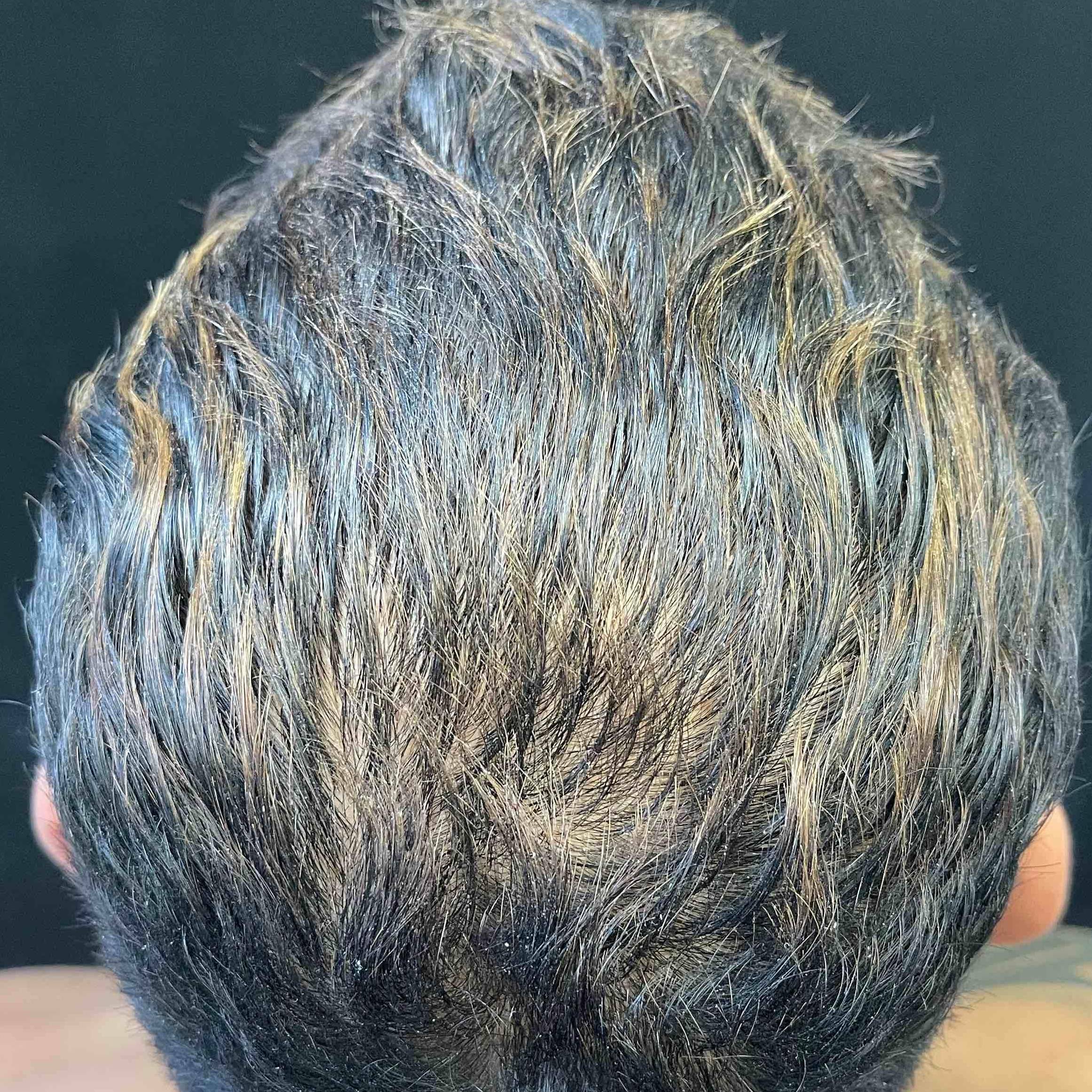 Exoflo-Hair Restoration Before and After Case 4 After