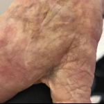 SRT-100 Radiation Before and After Case 27 After