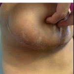SRT-100 Radiation Before and After Case 53 After