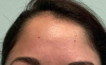 Acne Before and After Case 15 Before