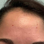 Acne Before and After Case 15 Before