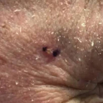 Skin Cancer Before and After Case 24 Before