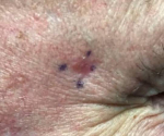 Skin Cancer Before and After Case 24 After