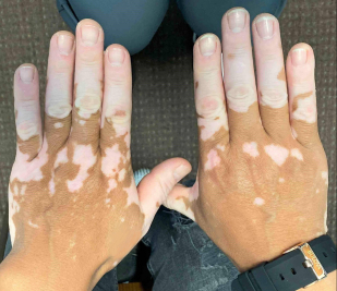 Vitiligo Before and After Case 1 