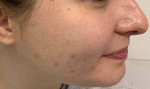 Acne Before and After Case 16 Before